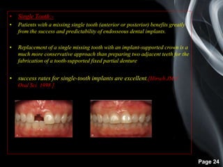 Page 24
• Single Tooth:-
• Patients with a missing single tooth (anterior or posterior) benefits greatly
from the success and predictability of endosseous dental implants.
• Replacement of a single missing tooth with an implant-supported crown is a
much more conservative approach than preparing two adjacent teeth for the
fabrication of a tooth-supported fixed partial denture
• success rates for single-tooth implants are excellent.[Hirsch JM J
Oral Sci 1998 ]
 