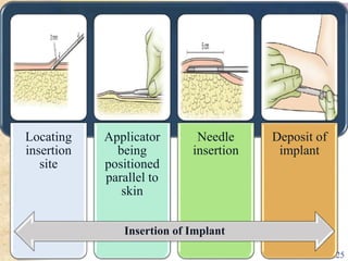 Locating
insertion
site
Applicator
being
positioned
parallel to
skin
Needle
insertion
Deposit of
implant
Insertion of Implant
25
 