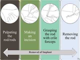 Palpating
the
rod/rods
Making
an
incision
Grasping
the rod
with crile
forceps
Removing
the rod
Removal of Implant
26
 