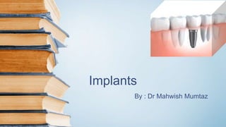 Implants
By : Dr Mahwish Mumtaz
 