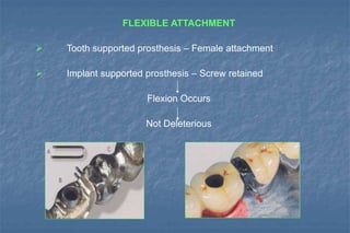 FLEXIBLE ATTACHMENT
 Tooth supported prosthesis – Female attachment
 Implant supported prosthesis – Screw retained
Flexion Occurs
Not Deleterious
 