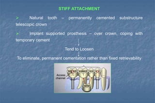STIFF ATTACHMENT
 Natural tooth – permanently cemented substructure
telescopic crown
 Implant supported prosthesis – over crown, coping with
temporary cement
Tend to Loosen
To eliminate, permanent cementation rather than fixed retrievability
 