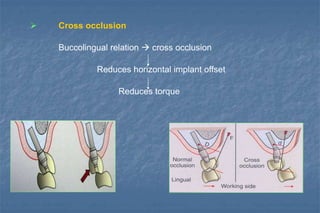 Cross occlusion
Buccolingual relation  cross occlusion
Reduces horizontal implant offset
Reduces torque
 