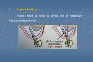  Implant Position
Implant head as close to center line of restoration –
Reduces horizontal offset.
 
