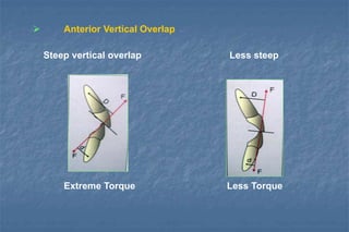  Anterior Vertical Overlap
Steep vertical overlap Less steep
Extreme Torque Less Torque
 