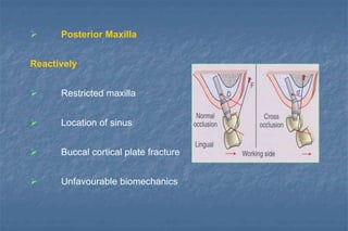  Posterior Maxilla
Reactively
 Restricted maxilla
 Location of sinus
 Buccal cortical plate fracture
 Unfavourable biomechanics
 