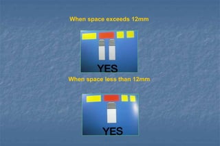When space exceeds 12mm
When space less than 12mm
 