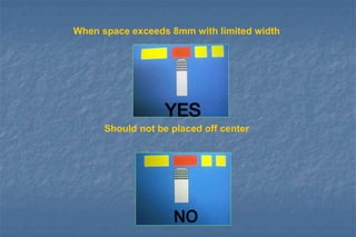 When space exceeds 8mm with limited width
Should not be placed off center
 