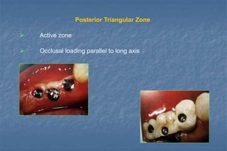 Posterior Triangular Zone
 Active zone
 Occlusal loading parallel to long axis
 