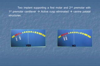 Two implant supporting a first molar and 2nd premolar with
1st premolar cantilever  Active cusp eliminated  canine palatal
structures.
 