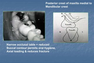 Narrow occlusal table + reduced
Buccal contour permits oral hygiene,
Axial loading & reduces fracture
Posterior crest of maxilla medial to
Mandibular crest
 