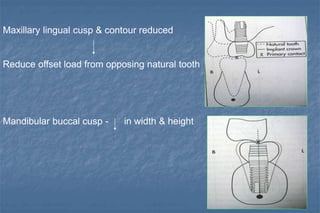 Maxillary lingual cusp & contour reduced
Reduce offset load from opposing natural tooth
Mandibular buccal cusp - in width & height
 