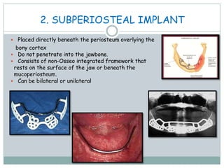 2. SUBPERIOSTEAL IMPLANT
 Placed directly beneath the periosteum overlying the
bony cortex
 Do not penetrate into the jawbone.
 Consists of non-Osseo integrated framework that
rests on the surface of the jaw or beneath the
mucoperiosteum.
 Can be bilateral or unilateral
 