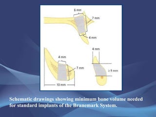 Dental Implants Procedures and Complications | PPT