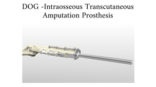 DOG -Intraosseous Transcutaneous
Amputation Prosthesis
 