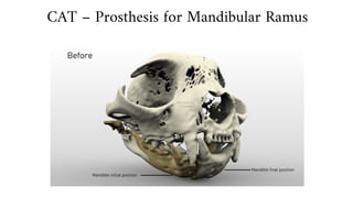 CAT – Prosthesis for Mandibular Ramus
 