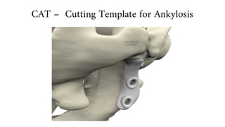 CAT – Cutting Template for Ankylosis
 
