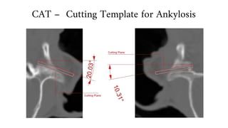 CAT – Cutting Template for Ankylosis
 