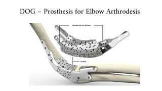 DOG – Prosthesis for Elbow Arthrodesis
 