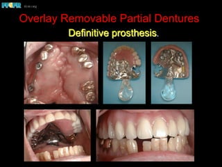 Overlay Temporary Denture Implants and rp ds | PDF