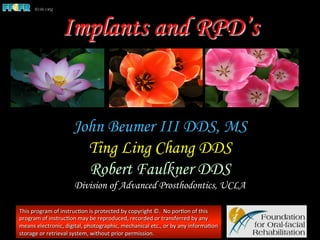 Implants and RPD’s
John Beumer III DDS, MS
Ting Ling Chang DDS
Robert Faulkner DDS
Division of Advanced Prosthodontics, UCLA
This	
  program	
  of	
  instruc1on	
  is	
  protected	
  by	
  copyright	
  ©.	
  	
  No	
  por1on	
  of	
  this	
  
program	
  of	
  instruc1on	
  may	
  be	
  reproduced,	
  recorded	
  or	
  transferred	
  by	
  any	
  
means	
  electronic,	
  digital,	
  photographic,	
  mechanical	
  etc.,	
  or	
  by	
  any	
  informa1on	
  
storage	
  or	
  retrieval	
  system,	
  without	
  prior	
  permission.	
  
 