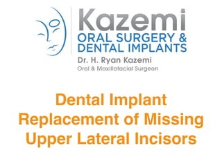 Dental Implant 
Replacement of Missing 
Upper Lateral Incisors 
 