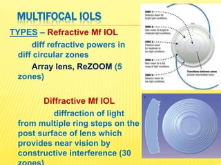 Implants in Ophthalmology | PPTX