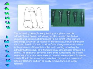 The increasing desire for early loading of implants used for
orthodontic anchorage led Melsen et al to develop the Aarhus
implant. Due to its small dimensions (6 mm length), this titanium
anchorage screw can be located in multiple sites, including between
the roots of teeth. It is said to allow Osseo-integration to occur even
in the presence of immediate orthodontic loading, providing the
orthodontic forces (25–50 g from Sentalloy springs) pass through the
screw. The strain that develops in the bone surrounding the loaded
screw leads to a local environment in which increased bone formation
results. Due to the size of the screw it can be used in a number of
different locations and can be easily removed when no longer
required.
 