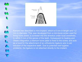 Kanomi has described a mini-implant, which is 6 mm in length and 1.2
mm in diameter. This was developed from a mini-bone screw used for
fixing bone plates, is screwed into the alveolus under local anesthetic,
to within 3 mm of the apices of the teeth. Subsequent to healing and
Osseo-integration, a titanium bone plate is fixed to the screw, and acts
as a hook for the attachment of an orthodontic ligature wire to aid
intrusion of the respective teeth. Due to potential oral hygiene
problems, the ligature is not attached directly to the implant.
 