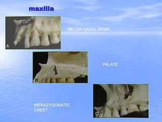 maxilla
BELOW NASAL SPINE
PALATE
INFRAZYGOMATIC
CREST
 