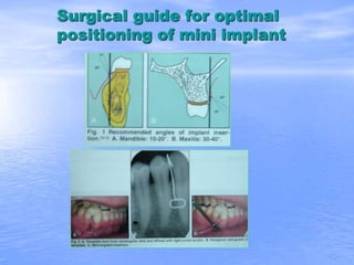 Surgical guide for optimal
positioning of mini implant
 