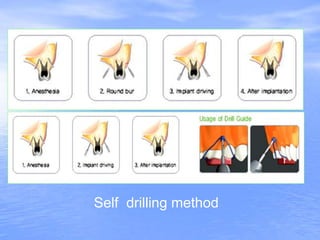 Self drilling method
 
