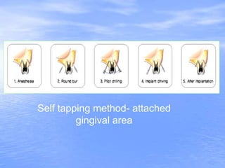 Self tapping method- attached
gingival area
 
