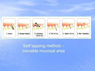 Self tapping method –
movable mucosal area
 