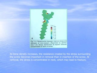 As bone density increases, the resistance created by the stress surrounding
the screw becomes important in removal than in insertion of the screw. At
removal, the stress is concentrated in neck, which may lead to fracture.
 