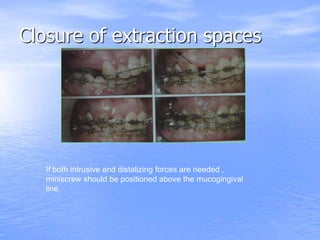 Closure of extraction spaces
If both intrusive and distalizing forces are needed ,
miniscrew should be positioned above the mucogingival
line.
 