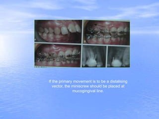 If the primary movement is to be a distalising
vector, the miniscrew should be placed at
mucogingival line.
 
