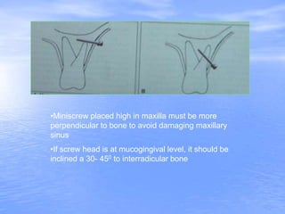 •Miniscrew placed high in maxilla must be more
perpendicular to bone to avoid damaging maxillary
sinus
•If screw head is at mucogingival level, it should be
inclined a 30- 450 to interradicular bone
 