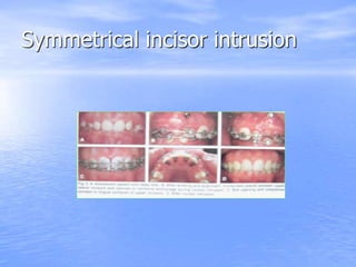 Symmetrical incisor intrusion
 