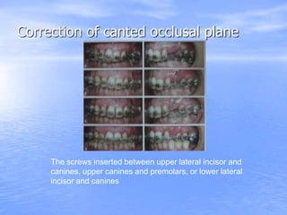Correction of canted occlusal plane
The screws inserted between upper lateral incisor and
canines, upper canines and premolars, or lower lateral
incisor and canines
 