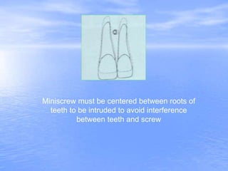 Miniscrew must be centered between roots of
teeth to be intruded to avoid interference
between teeth and screw
 