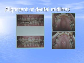 Alignment of dental midlines
 