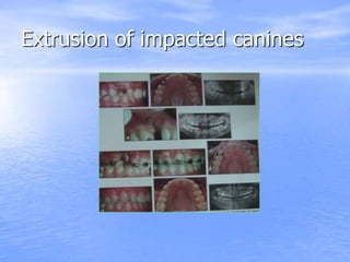 Extrusion of impacted canines
 
