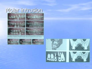 Molar intrusion
 
