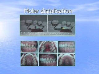 Molar distalisation
 