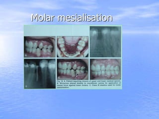 Molar mesialisation
 