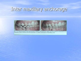 Inter maxillary anchorage
 