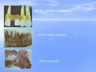 500 B C –Etruscan population
600 A D Mayan population
1700’s John Hunter
 