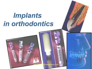 Implants
in orthodontics

www.indiandentalacademy.com

 