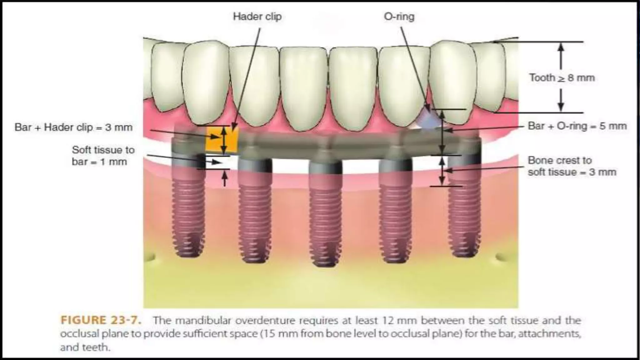 Implant supported overdenture | PPTX